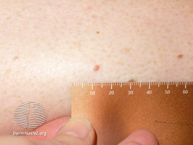 File:Amelanotic melanoma macro (DermNet NZ amelanotic-melanoma-99-of-125).jpg
