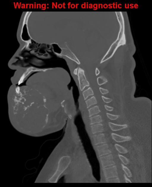Ameloblastoma (Radiopaedia 33126-34164 Sagittal bone window 41).jpg