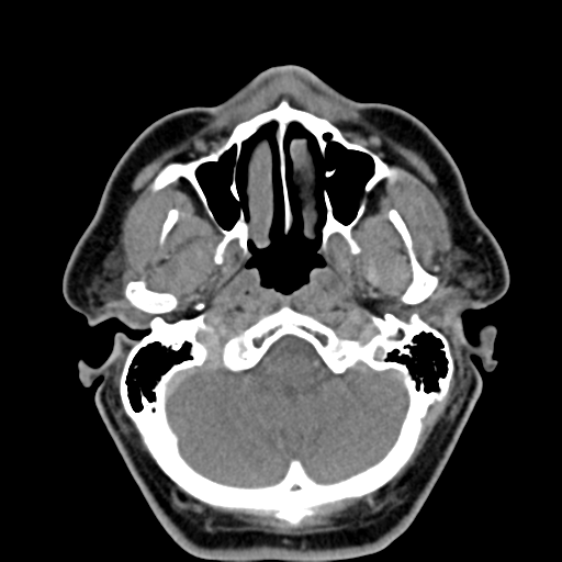 Ameloblastoma (Radiopaedia 38520-40623 Axial non-contrast 17).png