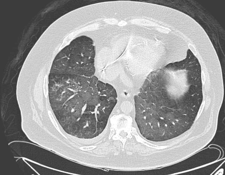 Amiodarone lung (Radiopaedia 62514-70769 Axial lung window 64).jpg