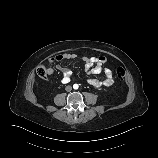 Ampullary adenocarcinoma (Radiopaedia 59373-66734 A 98).jpg