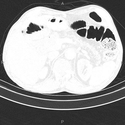 File:Ampullary adenocarcinoma (Radiopaedia 86093-102033 Axial lung window 57).jpg
