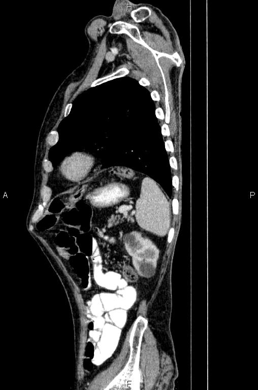 Ampullary adenocarcinoma (Radiopaedia 86093-102033 E 75).jpg