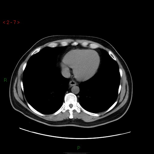 File:Ampullary carcinoma (Radiopaedia 56396-63056 Axial non-contrast 5).jpg