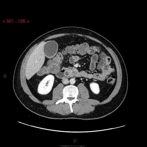 File:Ampullary carcinoma (Radiopaedia 56396-63056 C 51).jpg
