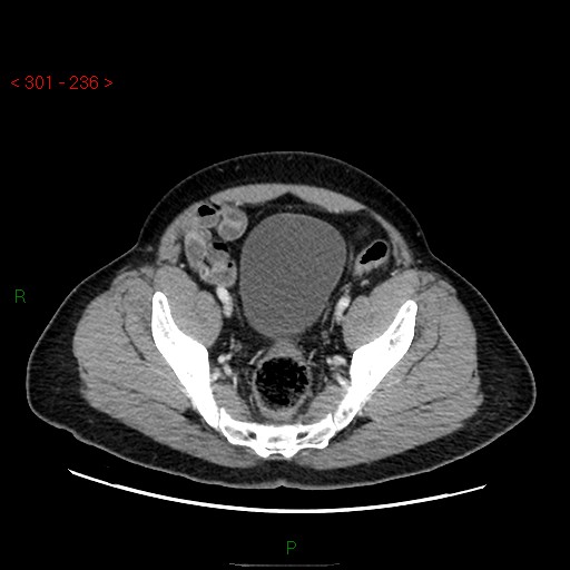 File:Ampullary carcinoma (Radiopaedia 56396-63056 C 85).jpg