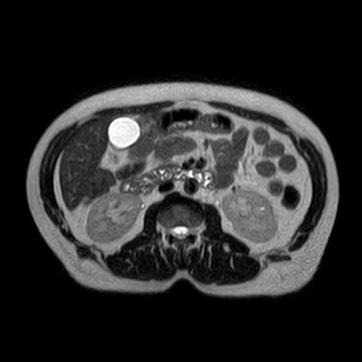 File:Ampullary tumor (Radiopaedia 27294-27479 T2 2).jpg