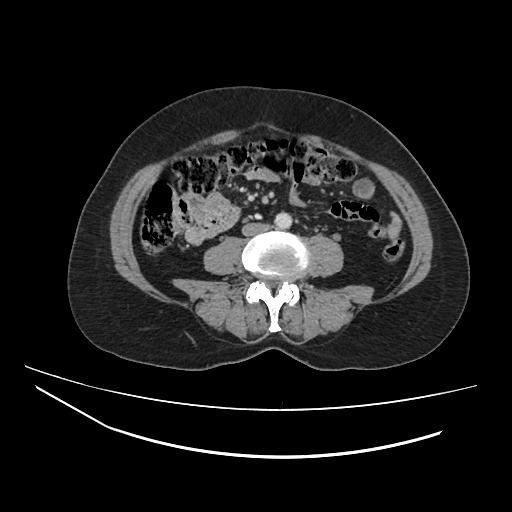 Ampullary tumor (Radiopaedia 60333-67998 A 48).jpg