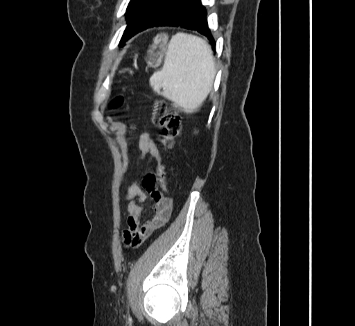 File:Ampullary tumor (Radiopaedia 60333-67998 C 52).jpg