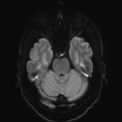 Amyotrophic lateral sclerosis (Radiopaedia 87352-103658 Axial DWI 36).jpg