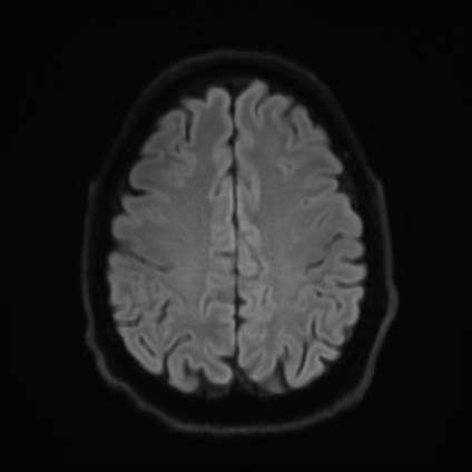 File:Amyotrophic lateral sclerosis (Radiopaedia 87352-103658 Axial DWI 49).jpg