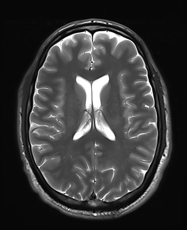 File:Amyotrophic lateral sclerosis (Radiopaedia 87352-103658 Axial T2 17).jpg