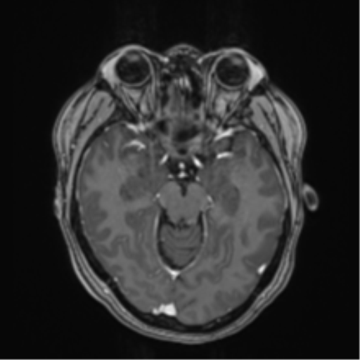 Anaplastic astroblastoma (Radiopaedia 55666-62194 Axial T1 C+ 29).png