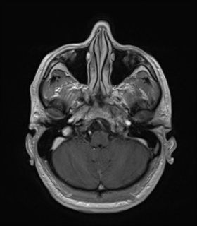 Anaplastic astrocytoma IDH wild-type (Radiopaedia 49984-55273 Axial T1 C+ 13).png
