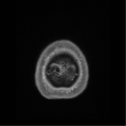 Anaplastic astrocytoma IDH wild-type (pseudoprogression) (Radiopaedia 42209-45276 Axial T1 C+ 144).png