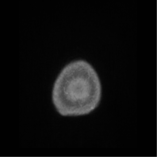 Anaplastic astrocytoma IDH wild-type (pseudoprogression) (Radiopaedia 42209-45276 Axial T1 C+ 150).png