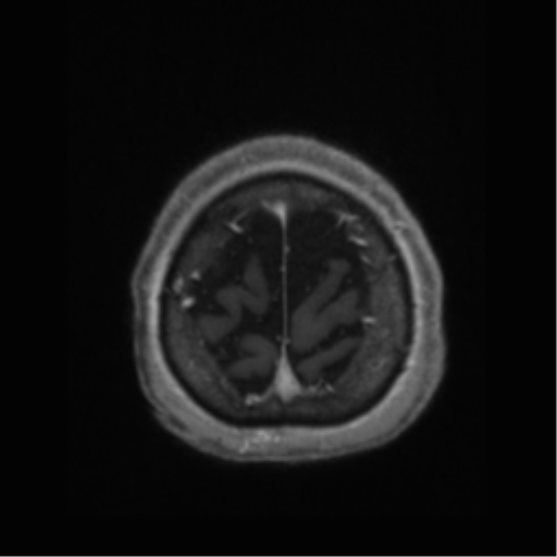 Anaplastic astrocytoma IDH wild-type (pseudoprogression) (Radiopaedia 42209-45277 Axial T1 C+ 118).png