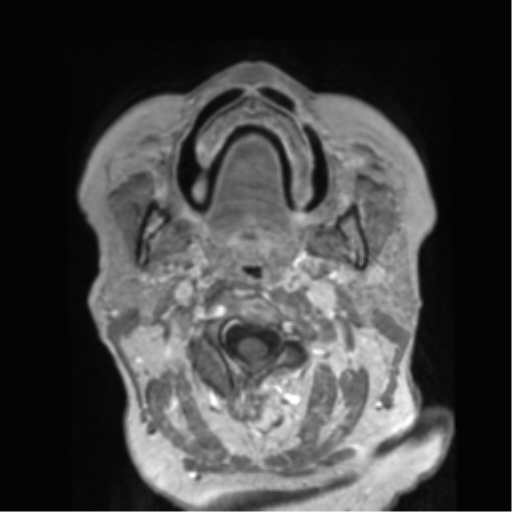 File:Anaplastic astrocytoma IDH wild-type (pseudoprogression) (Radiopaedia 42209-45278 Axial T1 C+ 1).png