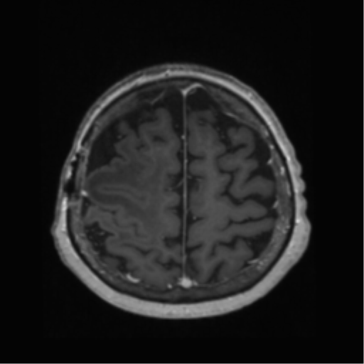 File:Anaplastic astrocytoma IDH wild-type (pseudoprogression) (Radiopaedia 42209-45278 Axial T1 C+ 121).png