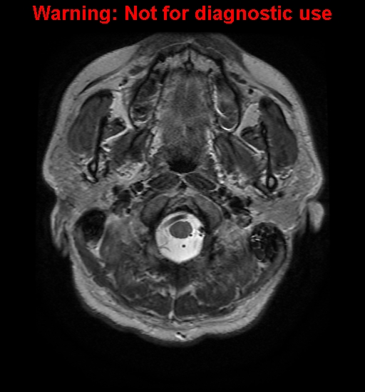 File:Anaplastic ganglioglioma (Radiopaedia 44921-48831 Axial T2 1).jpg