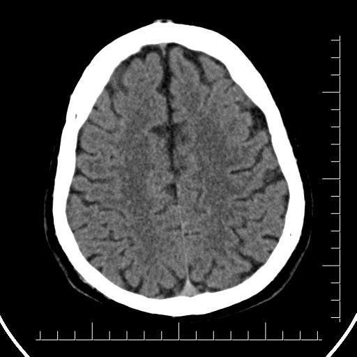 Aneurysm of posterior communicating artery (Radiopaedia 20188-20162 Axial non-contrast 36).jpg