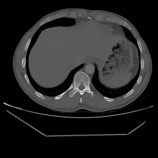 Aneurysmal bone cyst - rib (Radiopaedia 82167-96220 Axial bone window 211).jpg