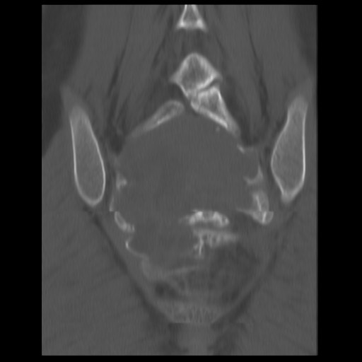 File:Aneurysmal bone cyst - sacrum (Radiopaedia 65190-74195 Coronal bone window 10).jpg