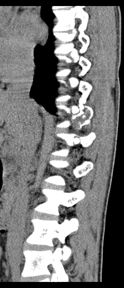 Aneurysmal bone cyst T11 (Radiopaedia 29294-29721 E 52).jpg
