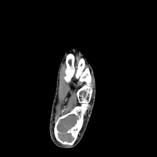 File:Aneurysmal bone cyst of the calcaneus (Radiopaedia 60669-68421 A 33).jpg