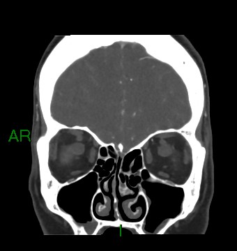 File:Aneurysmal subarachnoid hemorrhage with intra-axial extension (Radiopaedia 84371-99732 C 80).jpg