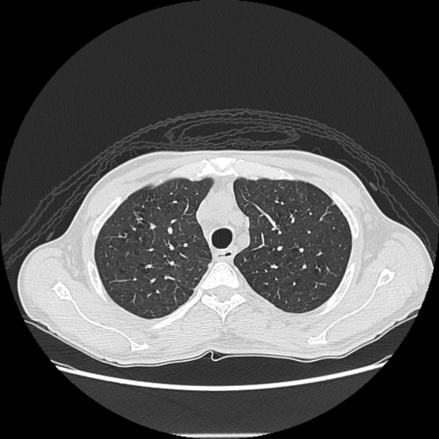 Angioinvasive aspergellosis (Radiopaedia 66995-76315 Axial lung window 10).jpg