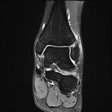 Ankle syndesmotic injury (Radiopaedia 69066-78837 Coronal PD fat sat 33).jpg