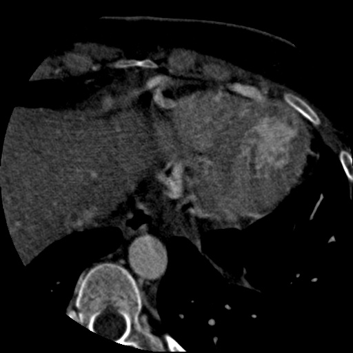 File:Anomalous left coronary artery from the pulmonary artery (ALCAPA) (Radiopaedia 40884-43586 A 76).jpg
