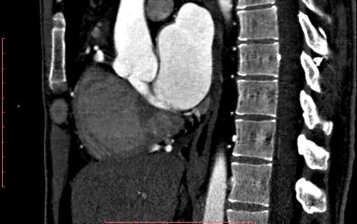 File:Anomalous left coronary artery from the pulmonary artery (ALCAPA) (Radiopaedia 70148-80181 C 109).jpg
