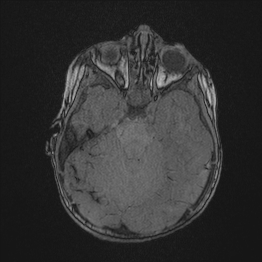 Anoxic brain injury (Radiopaedia 79165-92139 Axial MRA 71).jpg