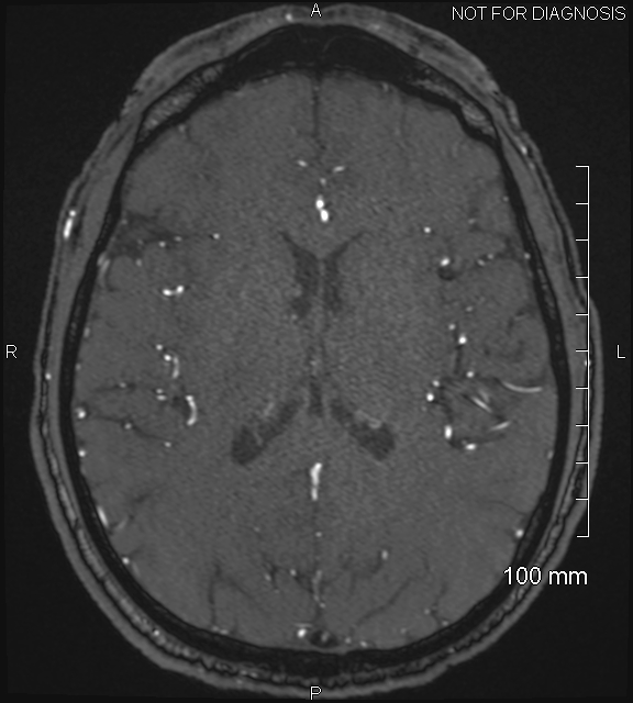 Anterior cerebral artery aneurysm (Radiopaedia 80683-94127 Axial MRA 143).jpg