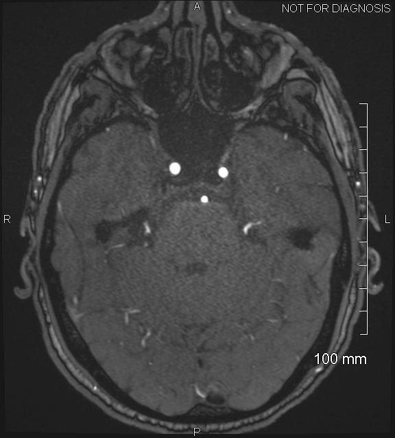 Anterior cerebral artery aneurysm (Radiopaedia 80683-94127 Axial MRA 71).jpg