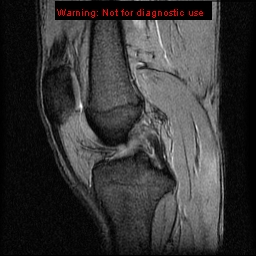 File:Anterior cruciate ligament injury - partial thickness tear (Radiopaedia 12176-12515 A 9).jpg