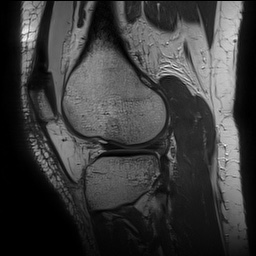 Anterior cruciate ligament rupture with Segond fracture (Radiopaedia 69043-78806 Sagittal PD 136).jpg