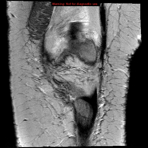 File:Anterior cruciate ligament tear (Radiopaedia 12329-12612 Coronal PD 2).jpg