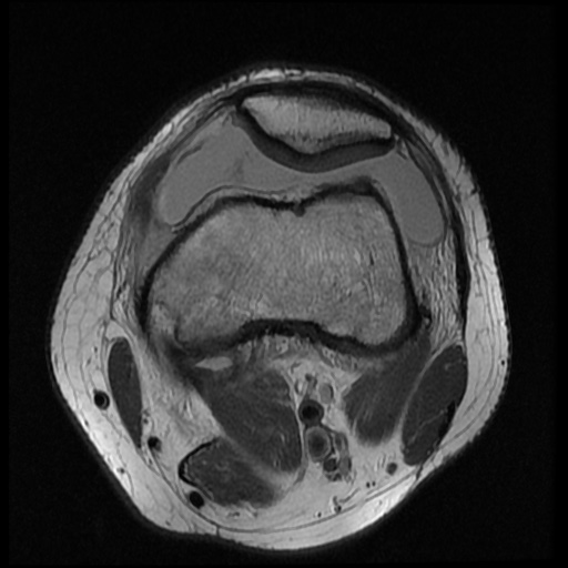 File:Anterior cruciate ligament tear (Radiopaedia 61500-69462 Axial PD 5).jpg