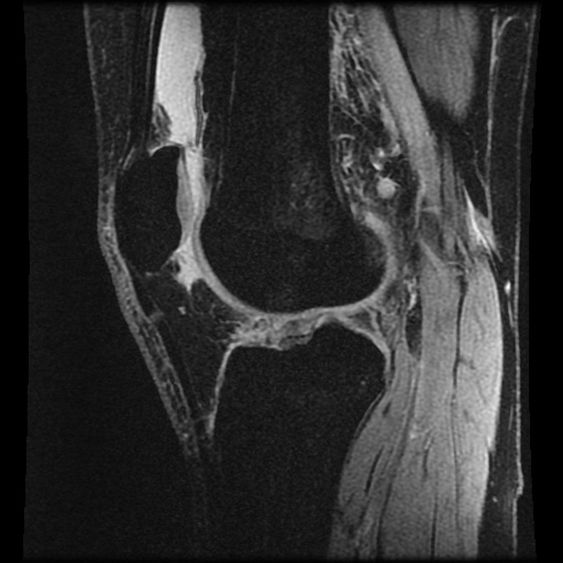 File:Anterior cruciate ligament tear (Radiopaedia 61500-69462 F 52).jpg