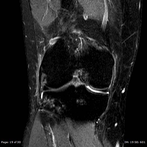 File:Anterior cruciate ligament tear (Radiopaedia 70783-80964 Coronal STIR 19).jpg