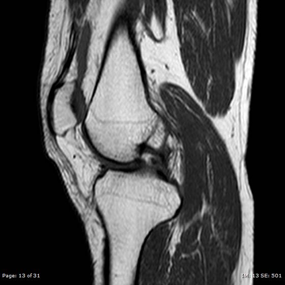 File:Anterior cruciate ligament tear (Radiopaedia 70783-80964 Sagittal T1 13).jpg