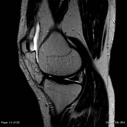 File:Anterior cruciate ligament tear (Radiopaedia 70783-80964 Sagittal T2 11).jpg