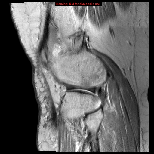 File:Anterior cruciate ligament tear - complete (Radiopaedia 12175-12514 Sagittal PD 4).jpg