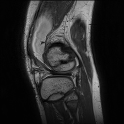 Anterior cruciate ligament tear - pediatric (Radiopaedia 62152-70260 Sagittal PD 142).jpg