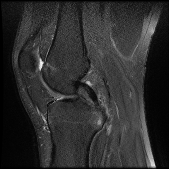 File:Anterior cruciate ligament tear with posteromedial corner injury, bucket-handle meniscal tear and chondral delamination (Radiopaedia 75501-86744 Sagittal PD fat sat 12).jpg