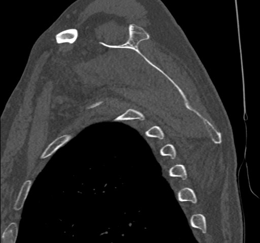 Anterior glenohumeral dislocation with Hill-Sachs lesion (Radiopaedia 62877-71249 Sagittal bone window 47).jpg