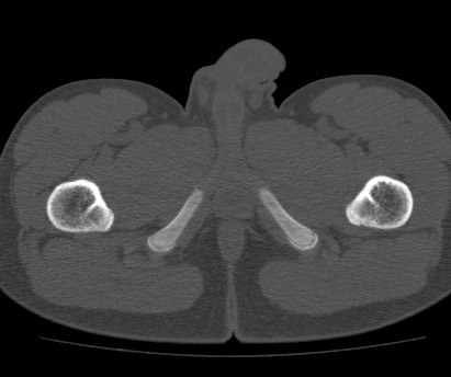 Anterior inferior iliac spine avulsion fracture (Radiopaedia 81312-94999 Axial bone window 73).jpg